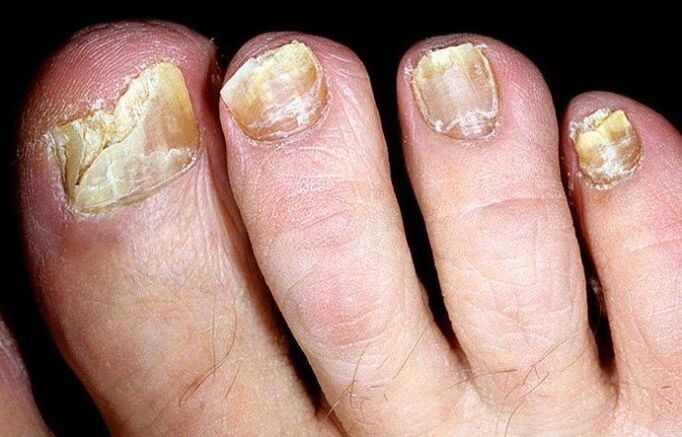 fungus on the nails